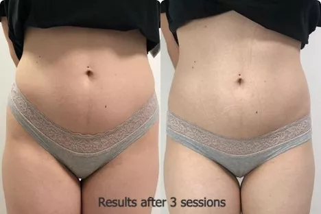 cryoskin before and after