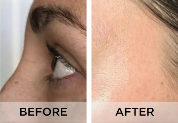 Pigmentation-before-and-after
