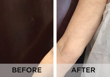 Skin-Tightening-before-and-after