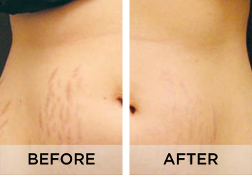 Stretch-Marks-before-and-after