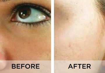 acne-scars-before-and-after