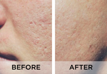 acne-scars-before-and-after