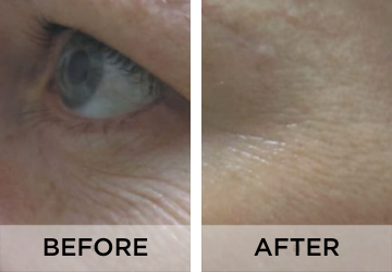 Fine-Lines-before-and-after-1.png