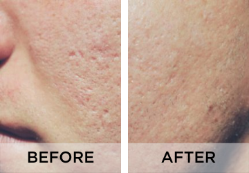 acne-scars-before-and-after-2-1.png