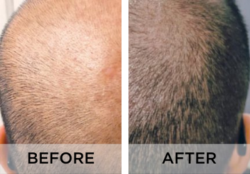 hairgrowth-before-and-after-1.png